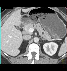 Adrenal Adenomas - CTisus CT Scan