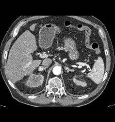 Metastatic Renal Cell Carcinoma to the Adrenal Gland - CTisus CT Scan