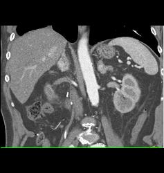 Metastatic Renal Cell Carcinoma to the Adrenal Gland - CTisus CT Scan