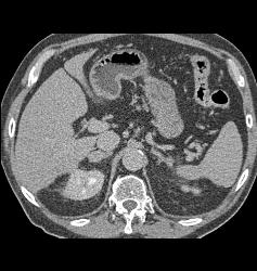 Metastatic Renal Cell Carcinoma to the Adrenal Gland - CTisus CT Scan