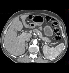 Adrenal Adenoma- Lipid Pool - CTisus CT Scan