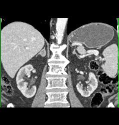 Adrenal Adenoma- Lipid Pool - CTisus CT Scan