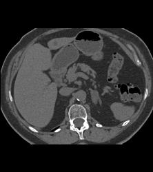 Adrenal Adenoma- Lipid Pool - CTisus CT Scan