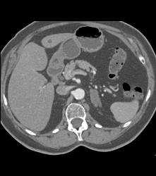 Adrenal Adenoma- Lipid Pool - CTisus CT Scan