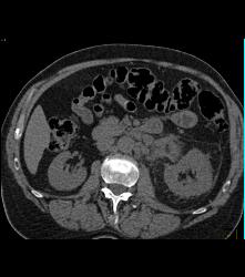 Primary Adrenal Carcinoma - CTisus CT Scan