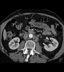 Primary Adrenal Carcinoma - CTisus CT Scan