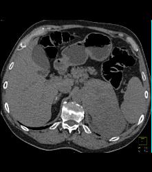 Primary Adrenal Carcinoma - CTisus CT Scan