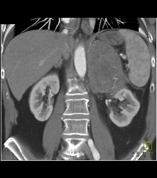 Primary Adrenal Carcinoma - CTisus CT Scan