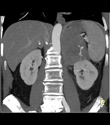 Primary Adrenal Carcinoma - CTisus CT Scan