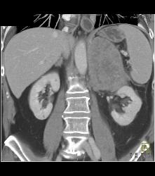 Primary Adrenal Carcinoma - CTisus CT Scan