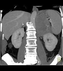 Primary Adrenal Carcinoma - CTisus CT Scan