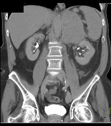 Primary Adrenal Carcinoma - CTisus CT Scan