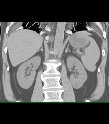 Minimal Adrenal Calcification C/w Tuberculosis (TB) to Adrenal Glands - CTisus CT Scan