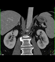 Minimal Adrenal Calcification C/w Tuberculosis (TB) to Adrenal Glands - CTisus CT Scan