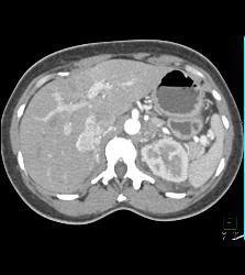 Pheochromocytoma - CTisus CT Scan