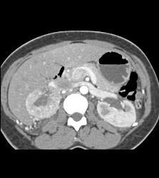 Pheochromocytoma - CTisus CT Scan