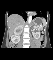 Pheochromocytoma - CTisus CT Scan