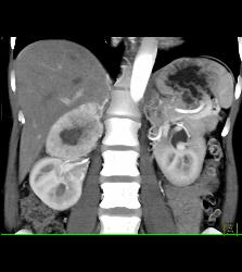 Pheochromocytoma - CTisus CT Scan