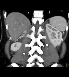 Pheochromocytoma - CTisus CT Scan