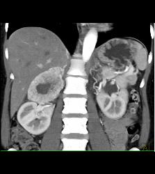 Pheochromocytoma - CTisus CT Scan