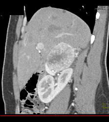 Pheochromocytoma - CTisus CT Scan