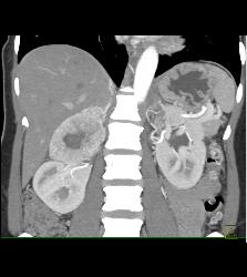 Pheochromocytoma - CTisus CT Scan