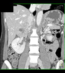 Pheochromocytoma - CTisus CT Scan