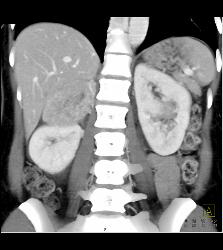 Pheochromocytoma - CTisus CT Scan