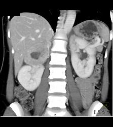 Pheochromocytoma - CTisus CT Scan