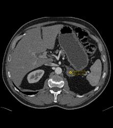 Adrenal Adenoma - CTisus CT Scan