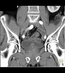 Adrenal Adenoma - CTisus CT Scan