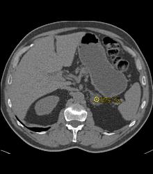 Adrenal Adenoma - CTisus CT Scan