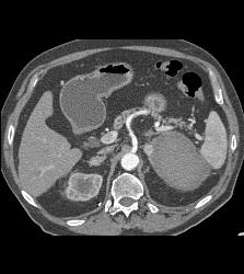 Acute Bleed in Left Adrenal Gland Which Had A Focus of Tumor as Well - CTisus CT Scan