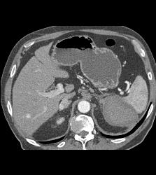 Acute Bleed in Left Adrenal Gland Which Had A Focus of Tumor as Well - CTisus CT Scan