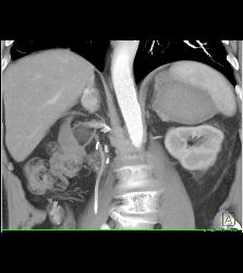 Acute Bleed in Left Adrenal Gland Which Had A Focus of Tumor as Well - CTisus CT Scan