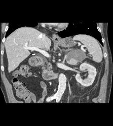 Acute Bleed in Left Adrenal Gland Which Had A Focus of Tumor as Well - CTisus CT Scan