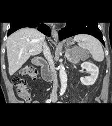 Acute Bleed in Left Adrenal Gland Which Had A Focus of Tumor as Well - CTisus CT Scan