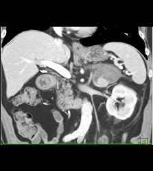 Acute Bleed in Left Adrenal Gland Which Had A Focus of Tumor as Well - CTisus CT Scan