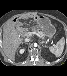 Adrenal Myelolipoma - CTisus CT Scan