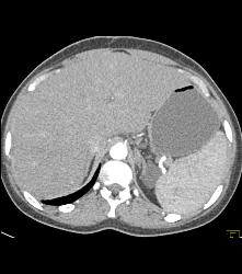 Gastric Pseudo Tumor - CTisus CT Scan