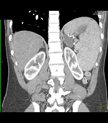 Gastric Pseudo Tumor - CTisus CT Scan