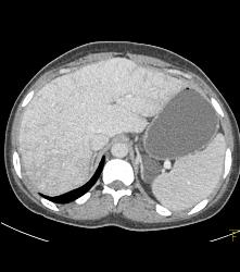 Gastric Pseudo Tumor - CTisus CT Scan