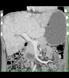 Gastric Pseudo Tumor - CTisus CT Scan