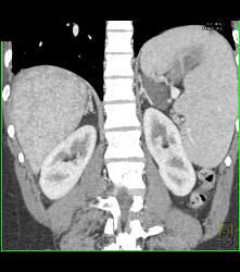 Gastric Pseudo Tumor - CTisus CT Scan