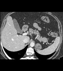 Gastric Pseudo Tumor - CTisus CT Scan