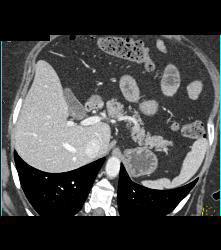 Gastric Pseudo Tumor - CTisus CT Scan