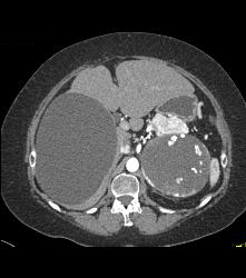 Islet Cell Tumor Tail of Pancreas and the Cystic Adrenal Mass Was An Old Hematoma - CTisus CT Scan