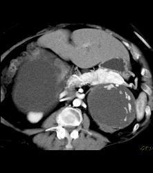 Islet Cell Tumor Tail of Pancreas and the Cystic Adrenal Mass Was An Old Hematoma - CTisus CT Scan