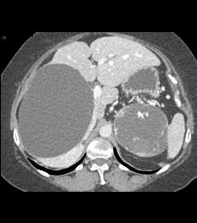 Islet Cell Tumor Tail of Pancreas and the Cystic Adrenal Mass Was An Old Hematoma - CTisus CT Scan