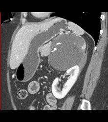 Islet Cell Tumor Tail of Pancreas and the Cystic Adrenal Mass Was An Old Hematoma - CTisus CT Scan